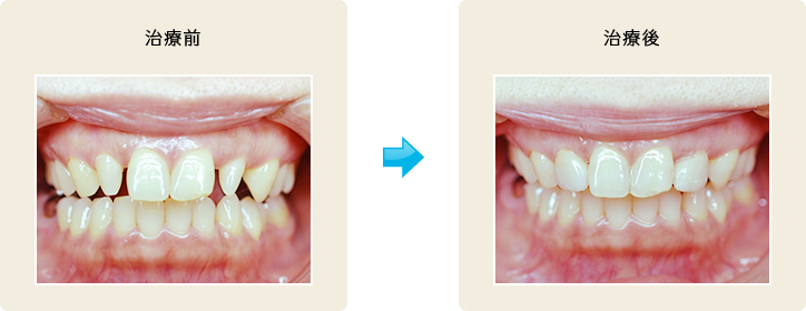e.max（イーマックス）ラミネートベニア 治療前/治療後