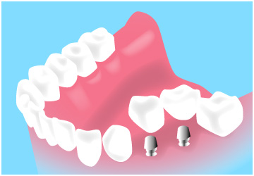 インプラント治療