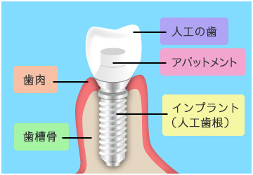 インプラントの構造