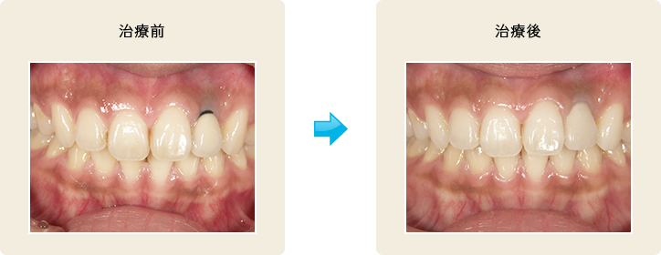 オールセラミック治療1 治療前/治療後