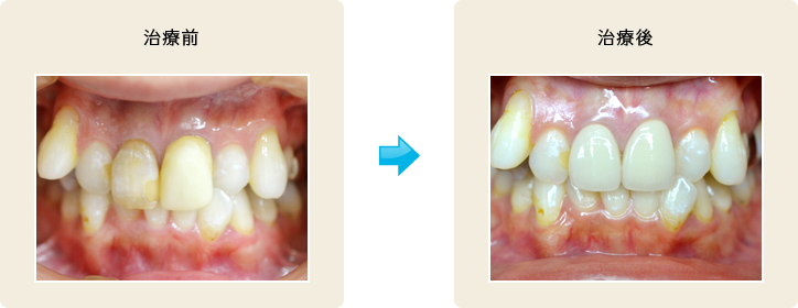 オールセラミック治療2 治療前/治療後