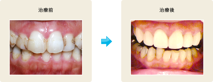 オールセラミック治療3 治療前/治療後
